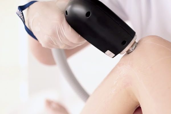 laser depilacion